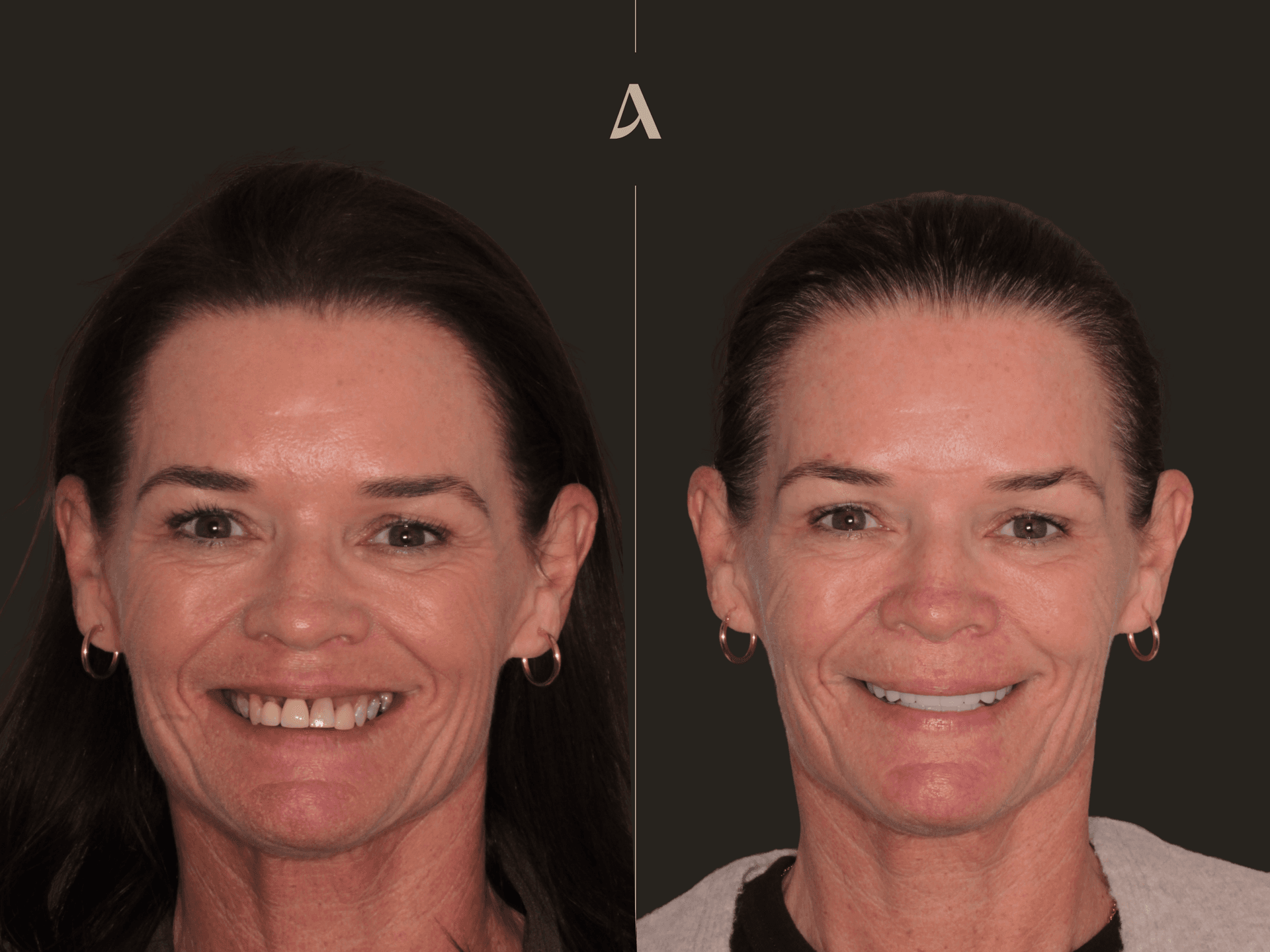 Implant, Zirconia Veneers, Complex Rehabilitation, Crown & Bridge – 12 months – ArtSmiles Gold Coast