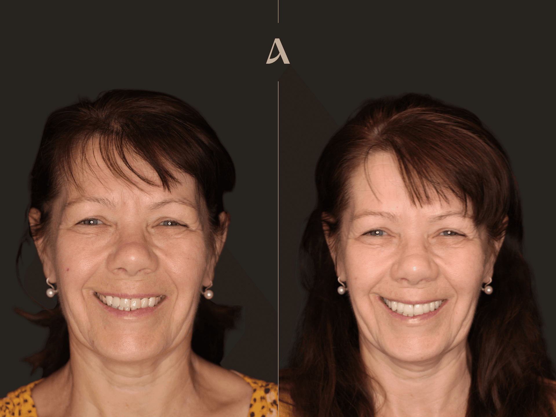 Crown & Bridge – 3 months – ArtSmiles Gold Coast