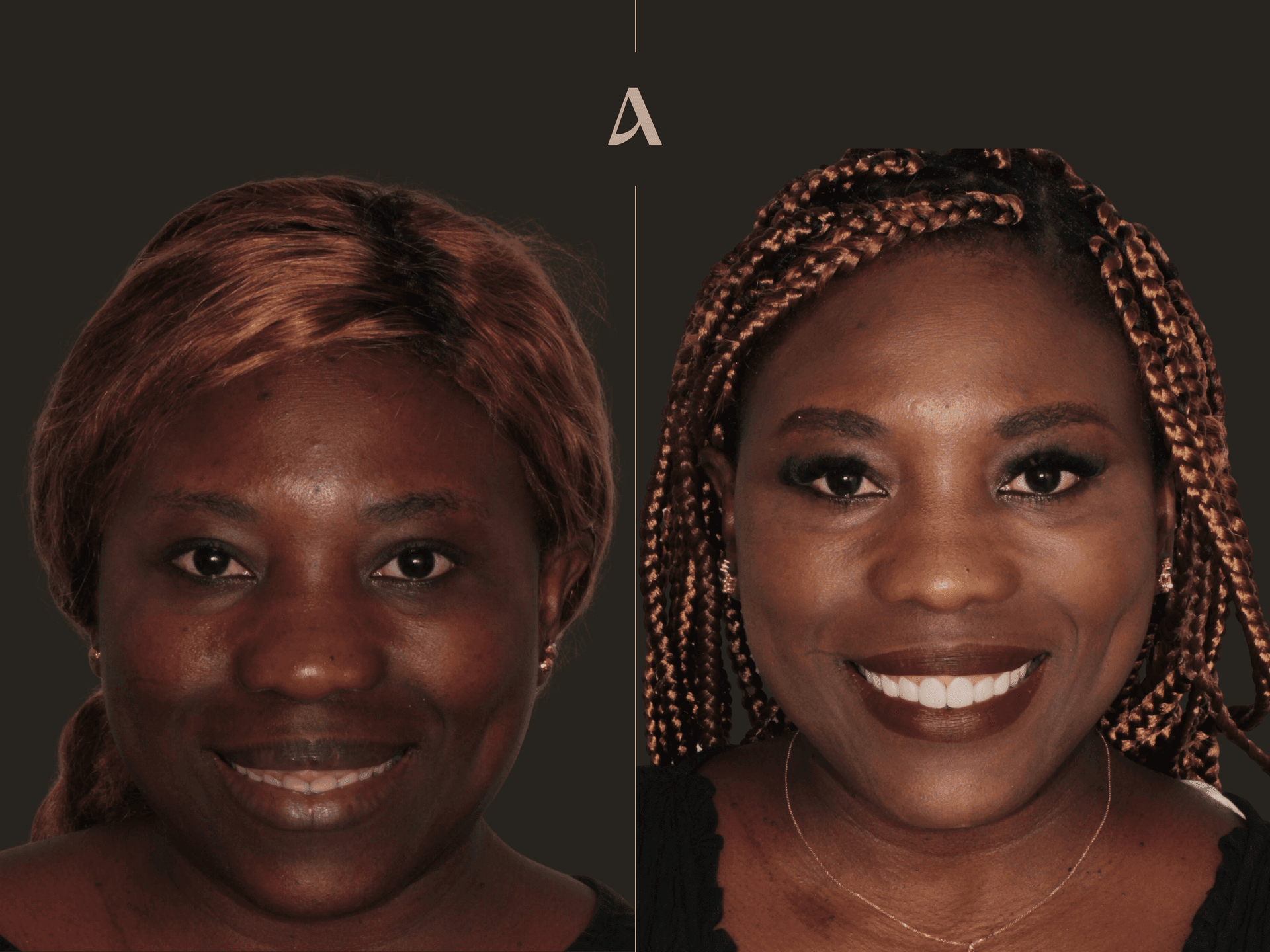 Gum Recontouring, Porcelain Veneers – 3 months – ArtSmiles Gold Coast