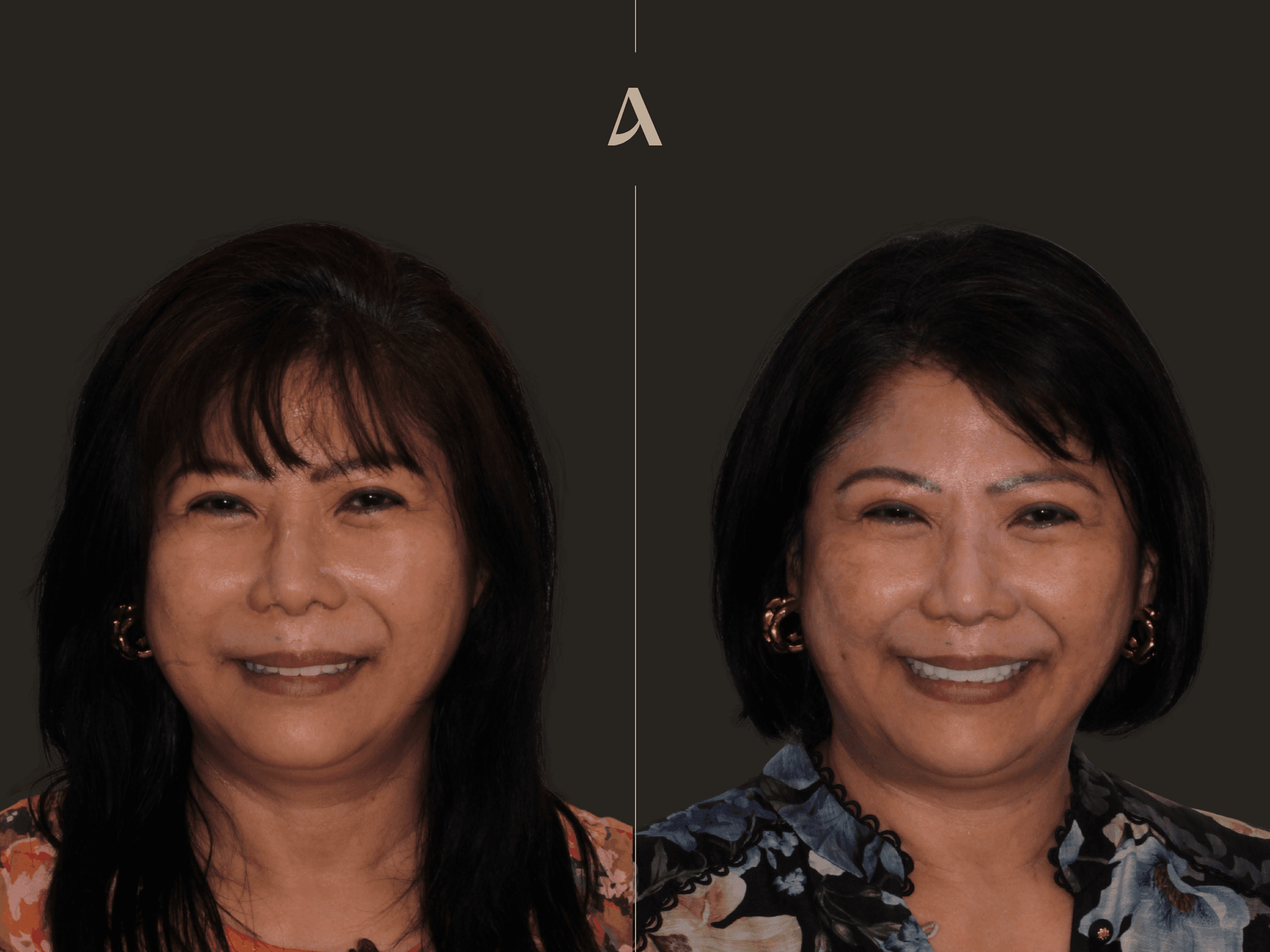 Increase Vertical Dimension, All on X – 6 months – ArtSmiles Gold Coast
