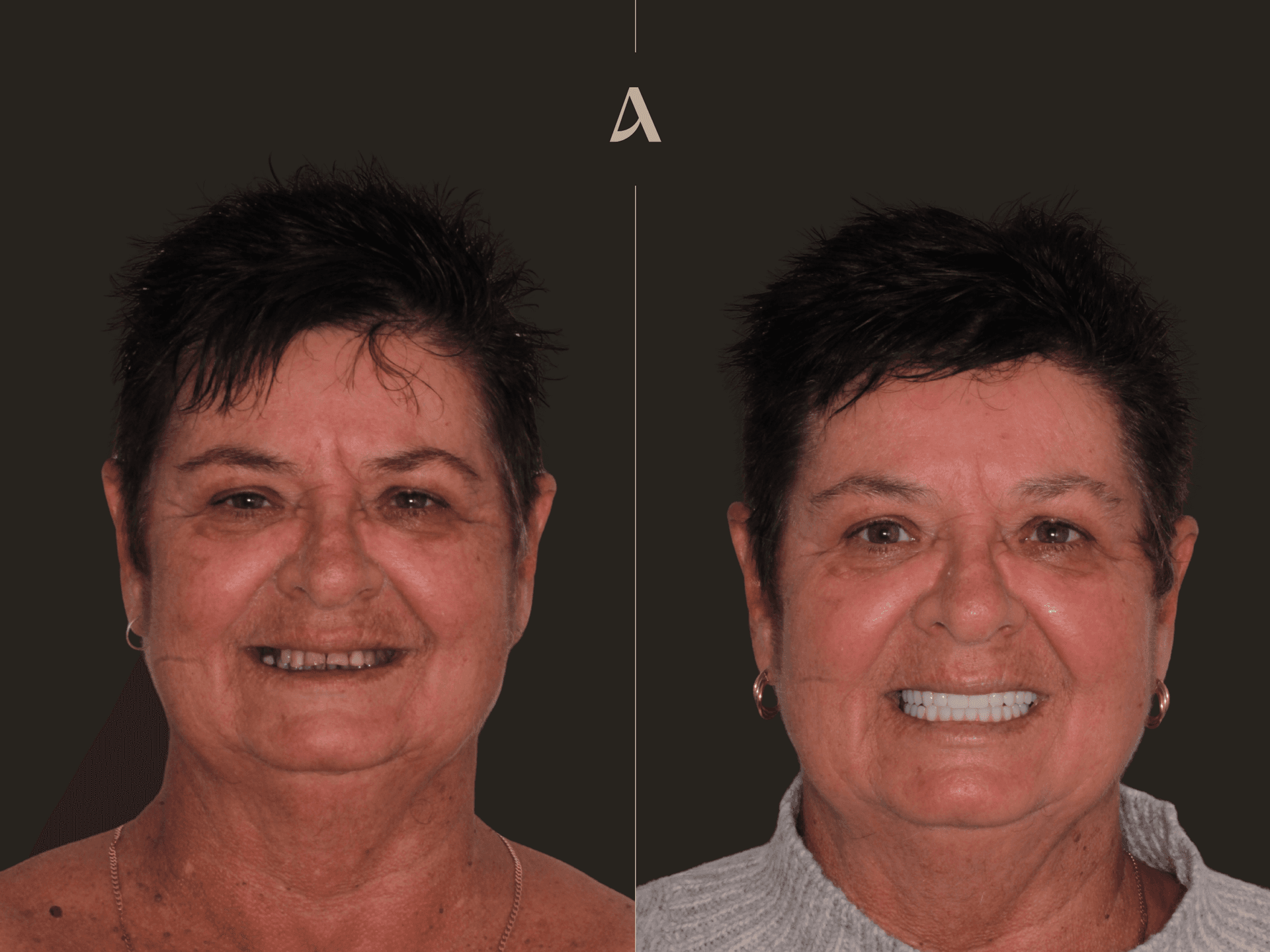 Increase Vertical Dimension, All on X – 6 months – ArtSmiles Gold Coast