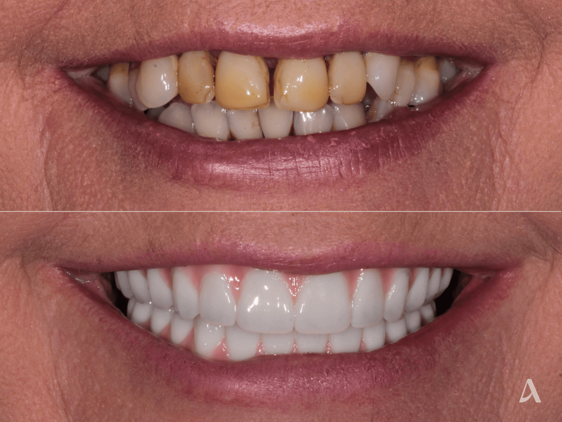 All on X, Gum Disease – 7 months – ArtSmiles Gold Coast