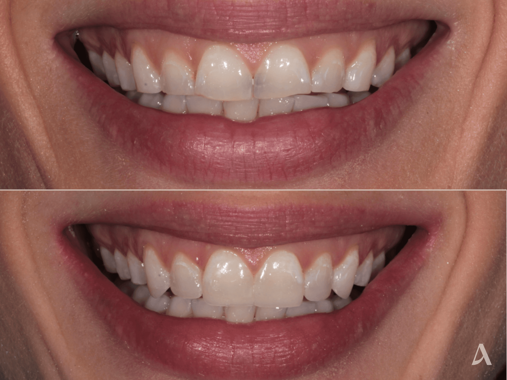 Composite Restorative – 1 month – ArtSmiles Gold Coast