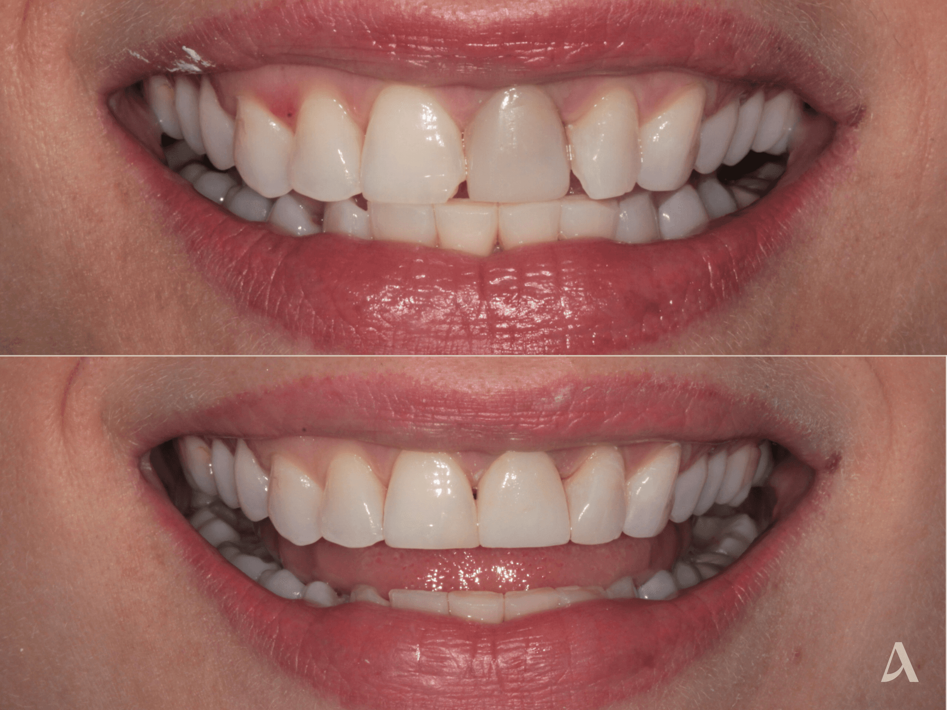 Composite Veneers