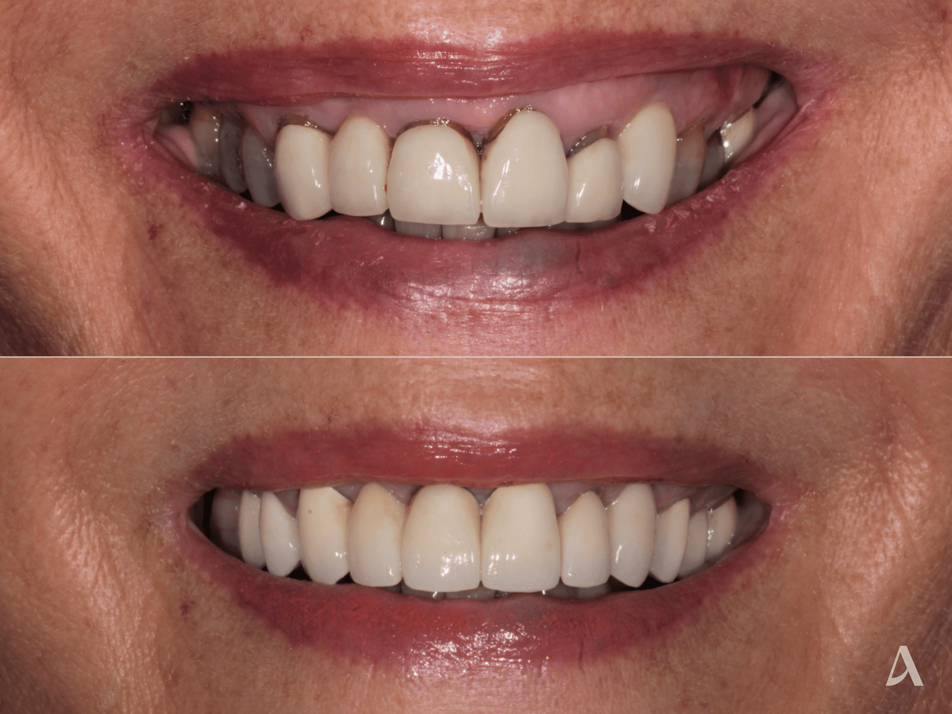 Crown & Bridge – 2 months – ArtSmiles Gold Coast