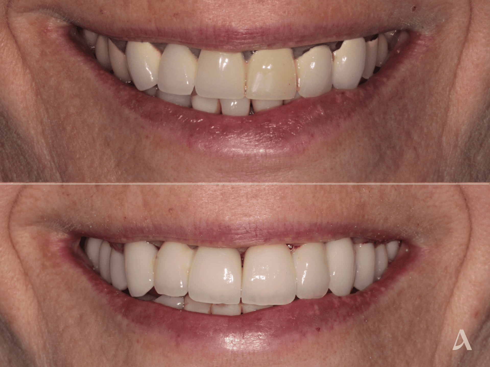 Crown & Bridge – 3 months – ArtSmiles Gold Coast