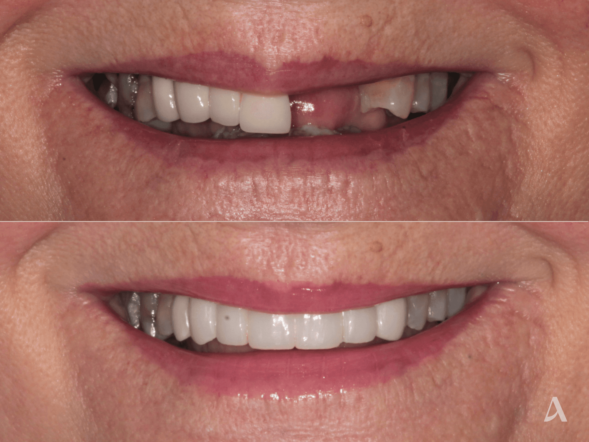Implant, Crown & Bridge – 5 months – ArtSmiles Gold Coast