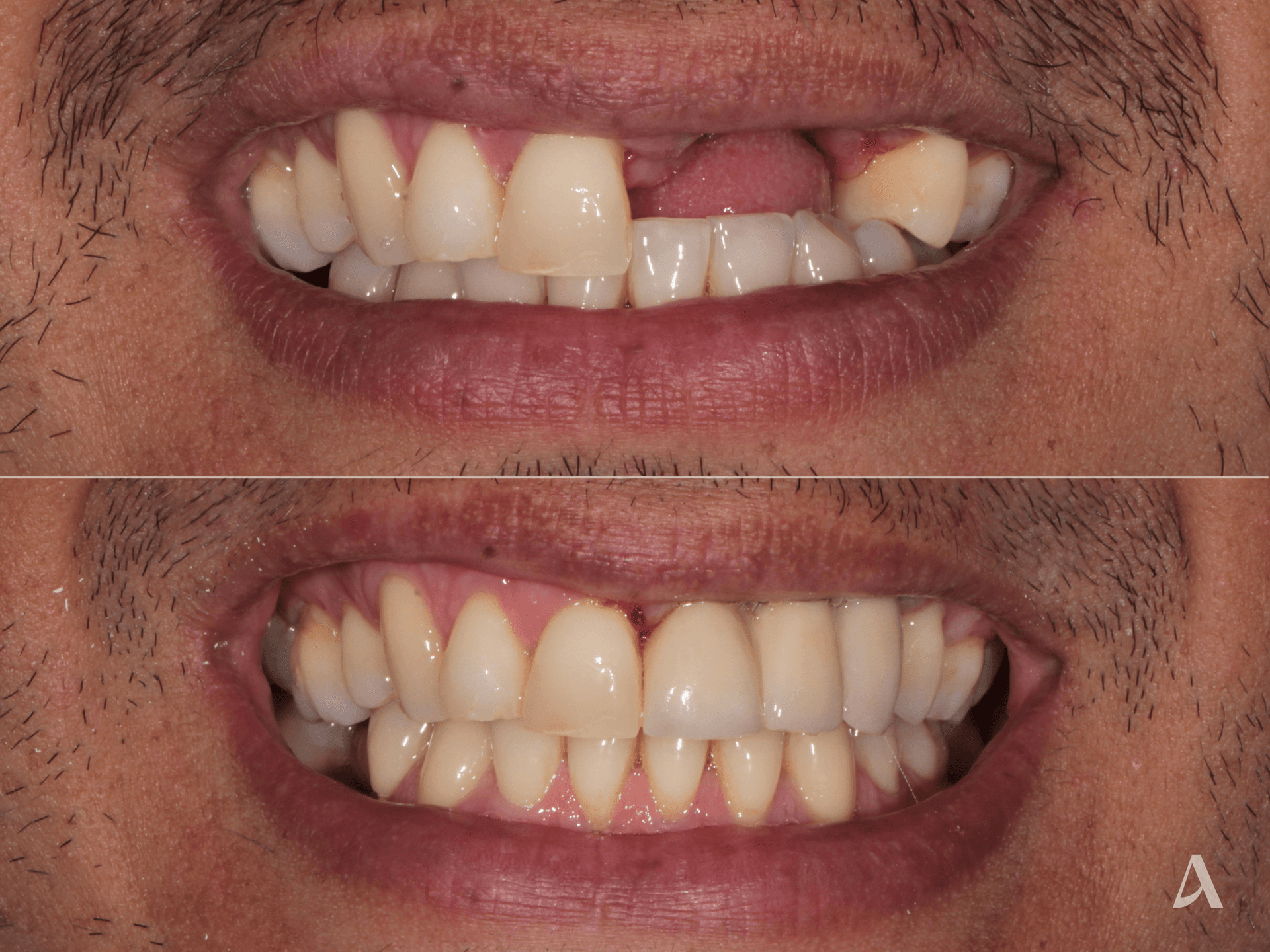 Implant, Gum Disease, Crown & Bridge – 3 months – ArtSmiles Gold Coast