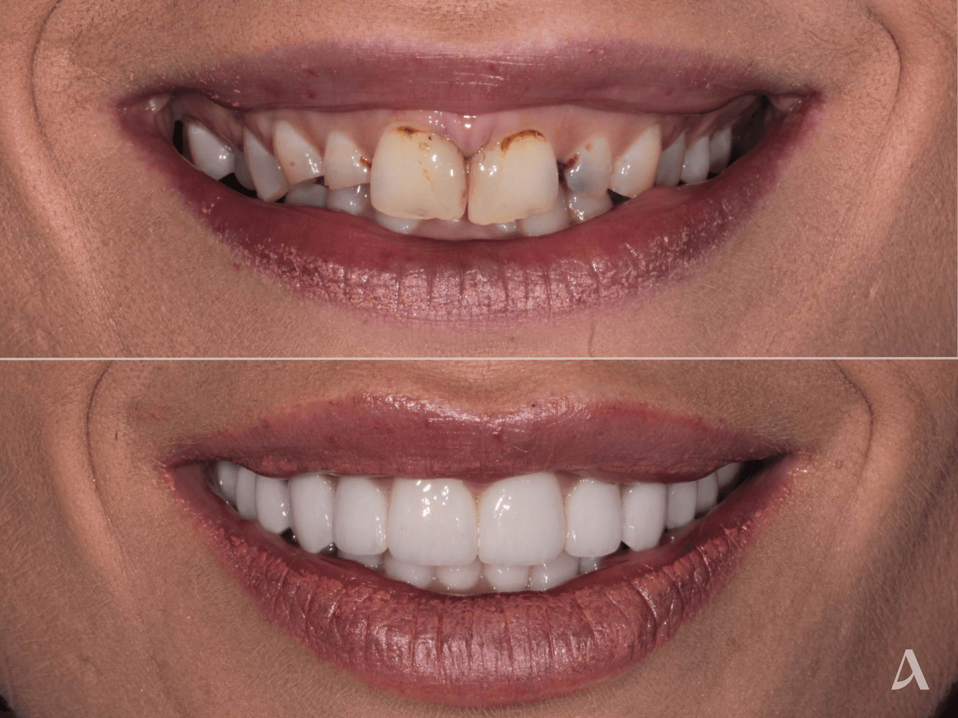 Porcelain Veneers, Complex Rehabilitation, Crown & Bridge – 1 month – ArtSmiles Gold Coast