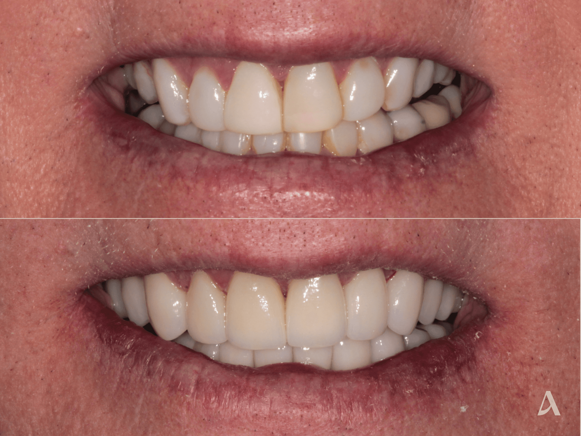Porcelain Veneers, Crown & Bridge, Complex Rehabilitation – 2 months – ArtSmiles Gold Coast