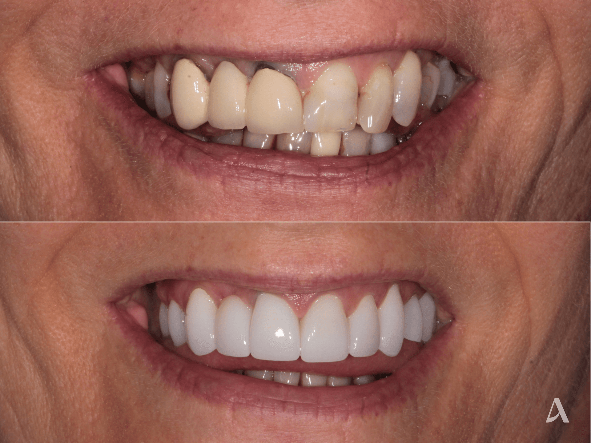 Zirconia Veneers, Crown & Bridge, Complex Rehabilitation – 6 months – ArtSmiles Gold Coast