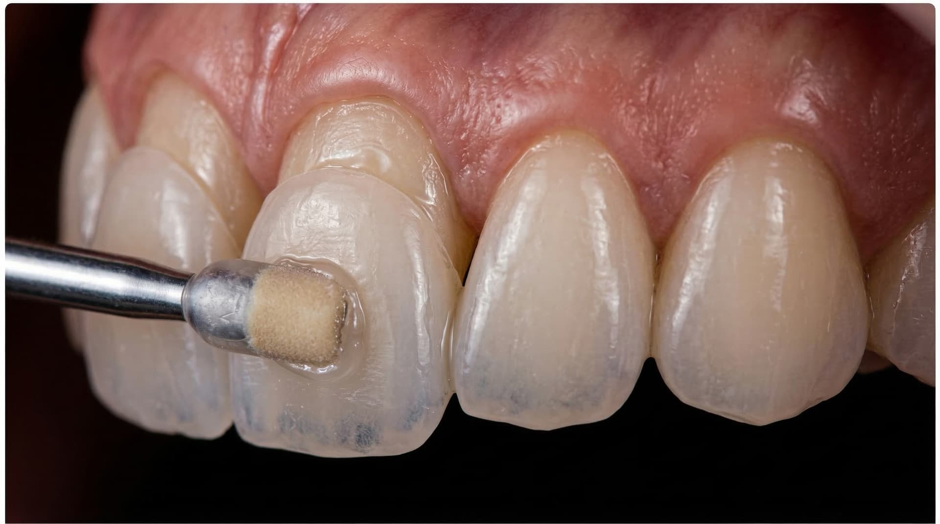 Dental veneer being placed on a tooth – cosmetic dentistry at ArtSmiles Gold Coast