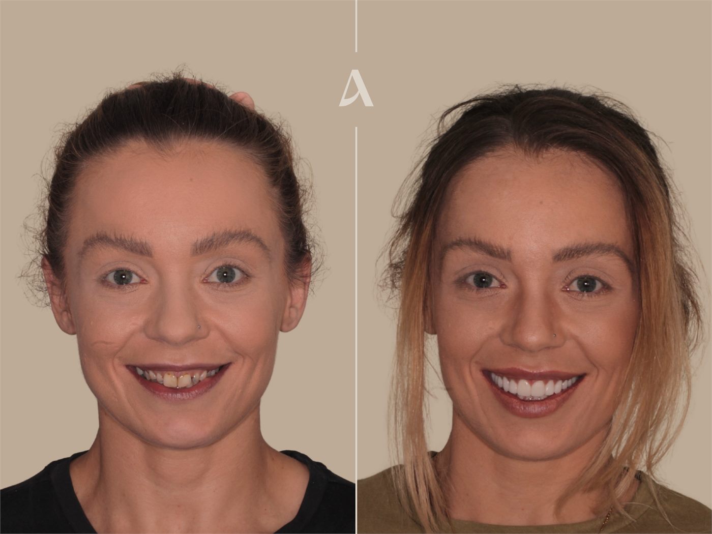 Porcelain veneers before and after — ArtSmiles patient