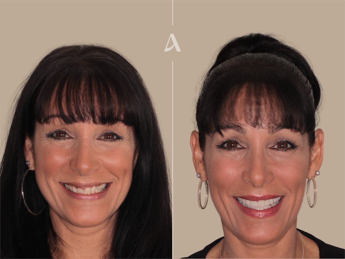 Porcelain veneers before and after — ArtSmiles patient