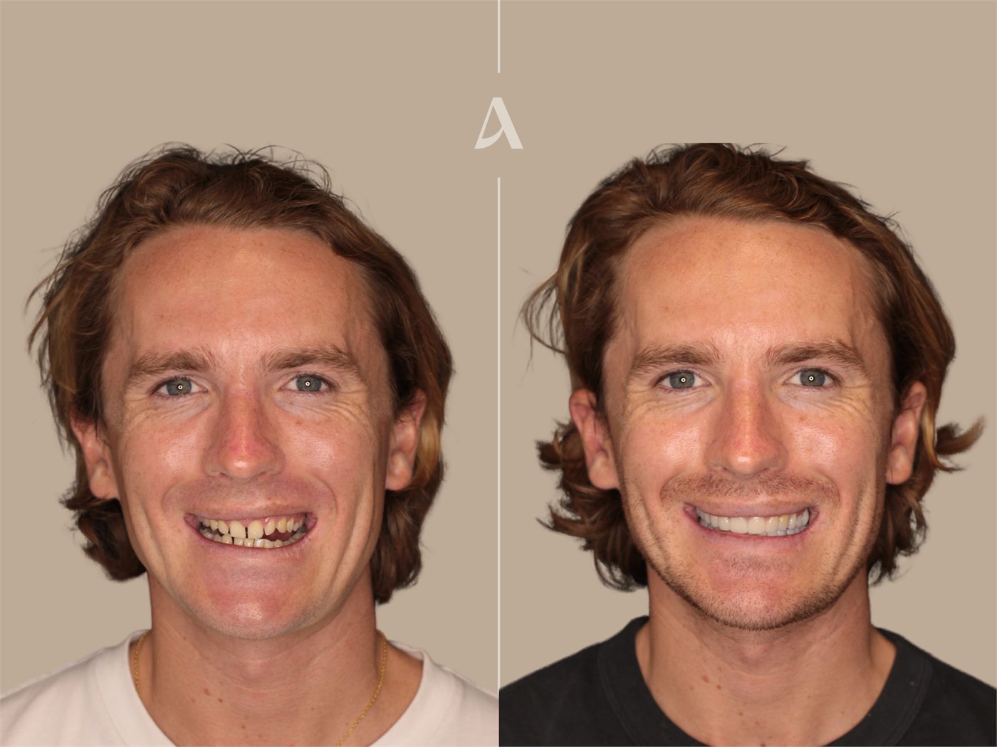 Porcelain veneers before and after — ArtSmiles patient
