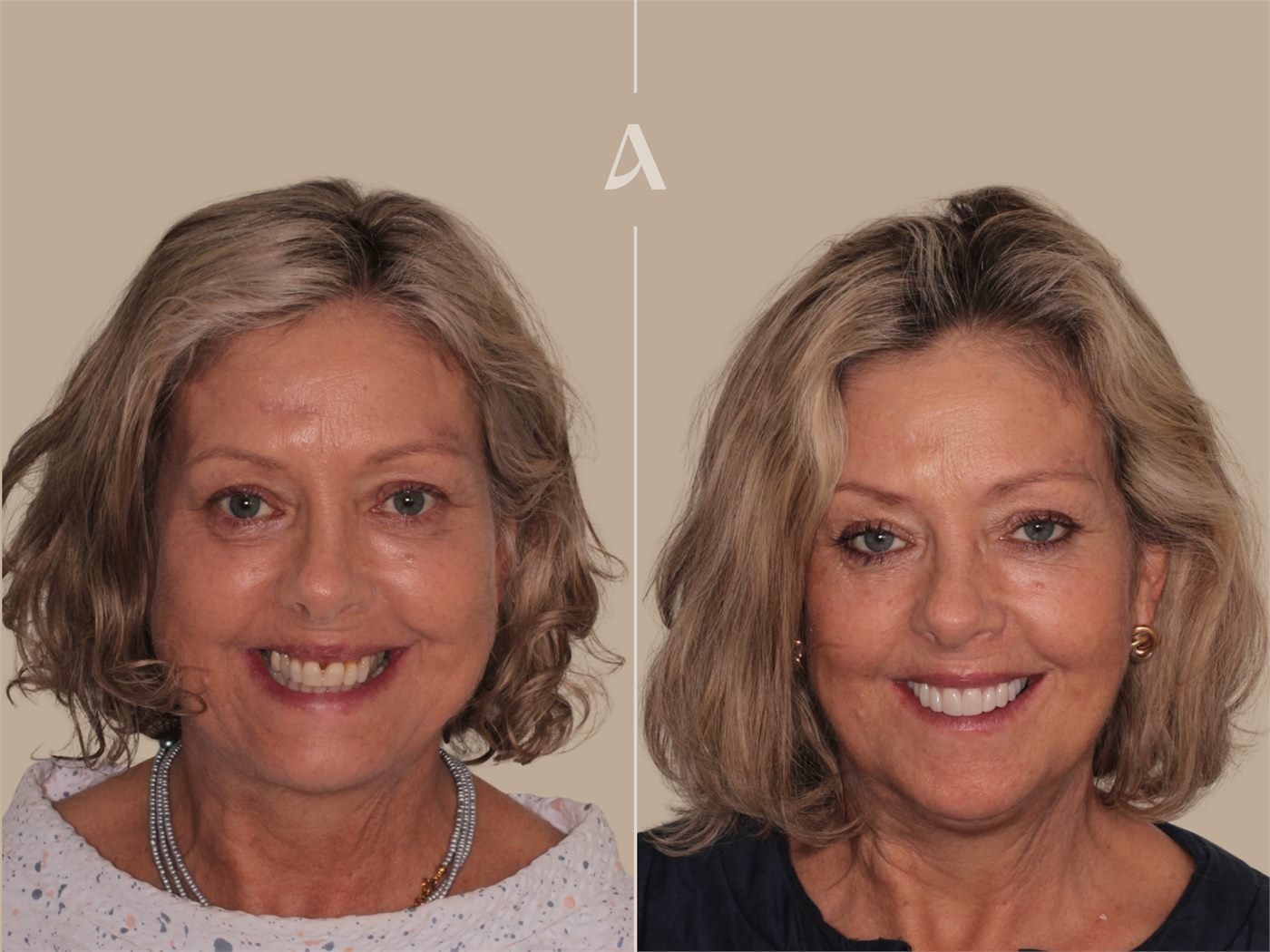 Porcelain veneers before and after — ArtSmiles patient