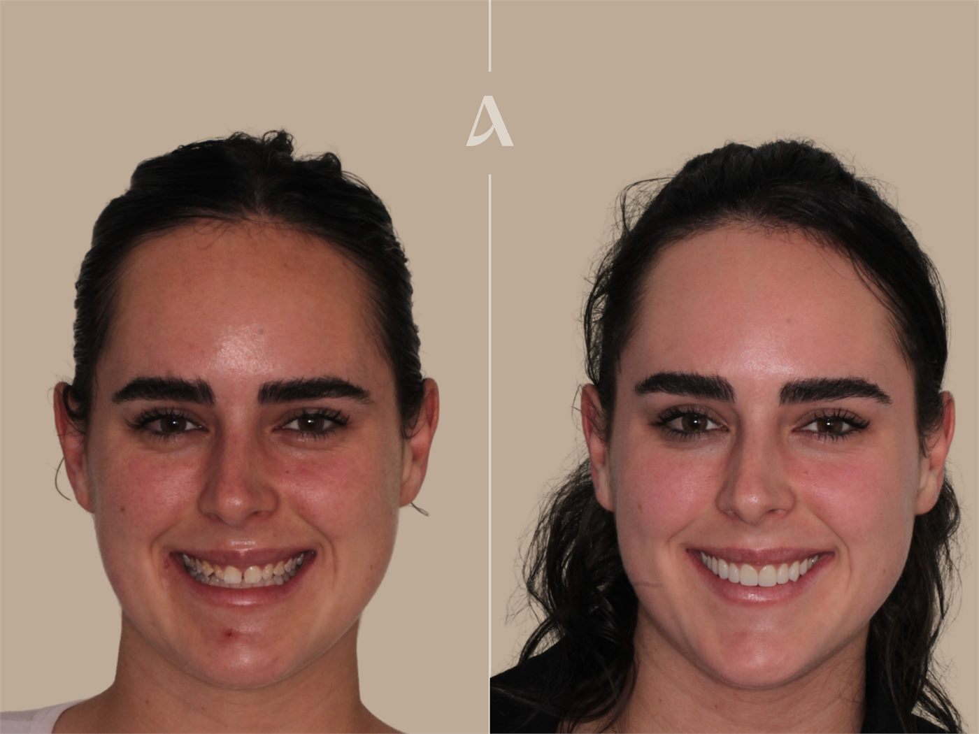 Porcelain veneers before and after — ArtSmiles patient