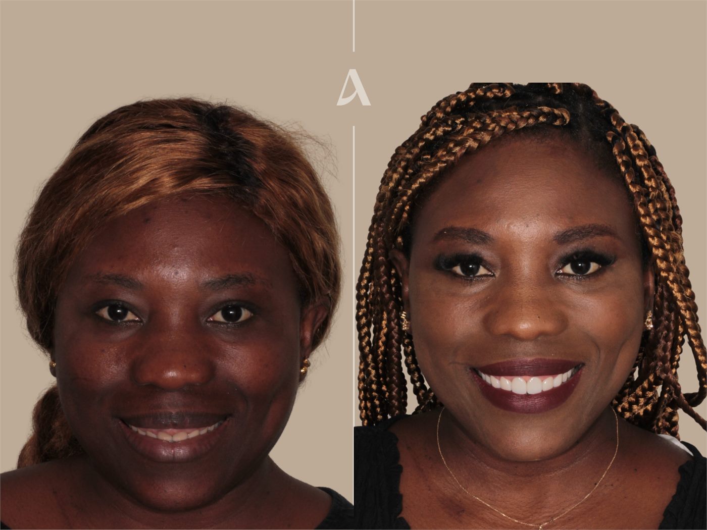 Porcelain veneers before and after — ArtSmiles patient