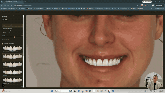 Trying a veneer design over the teeth in the Smile Studio